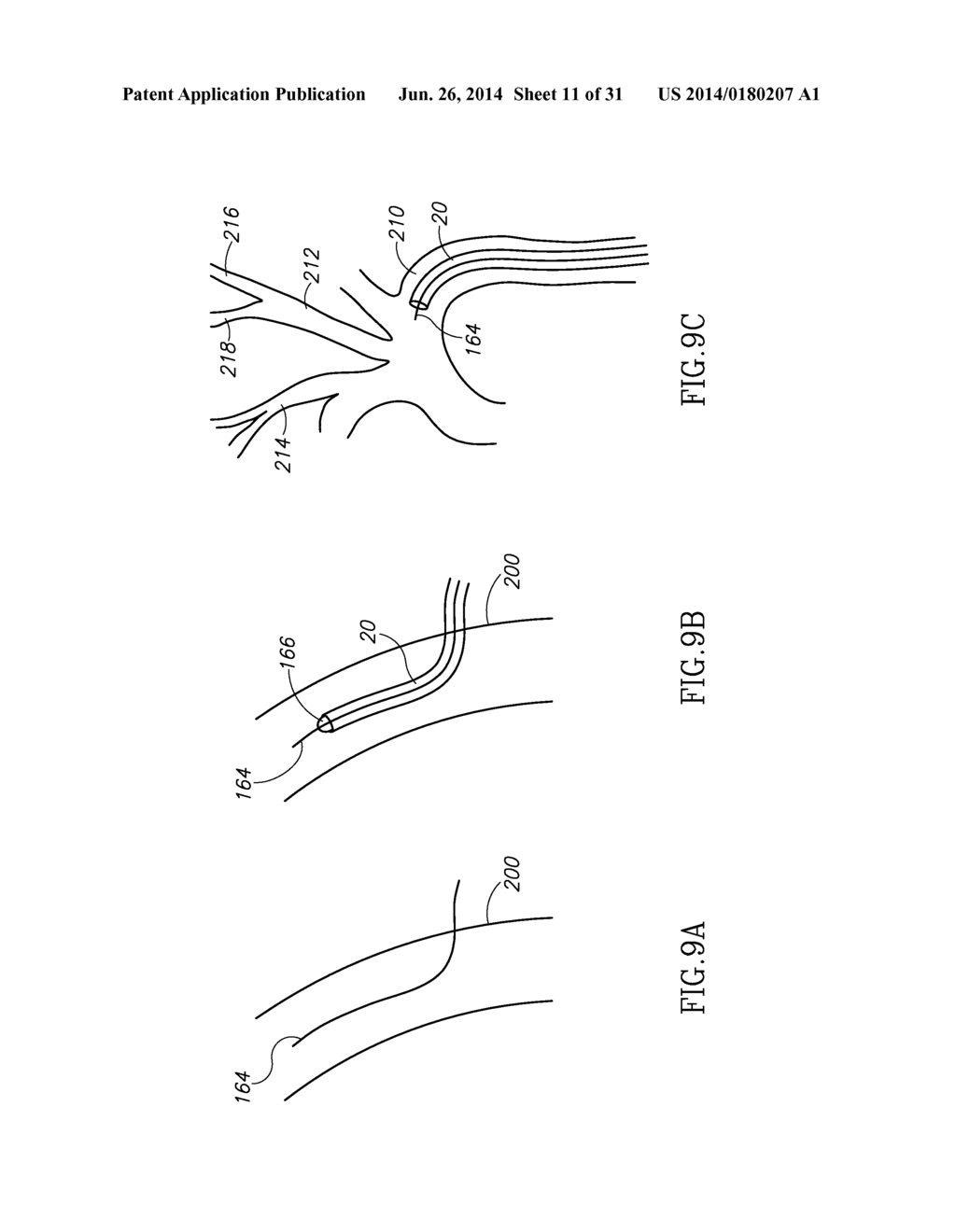 VARIABLE LENGTH CATHETER FOR DRUG DELIVERY - diagram, schematic, and image 12