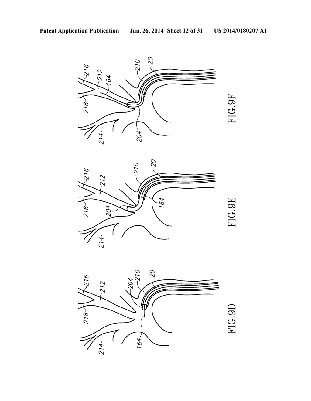 VARIABLE LENGTH CATHETER FOR DRUG DELIVERY - diagram, schematic, and image 13