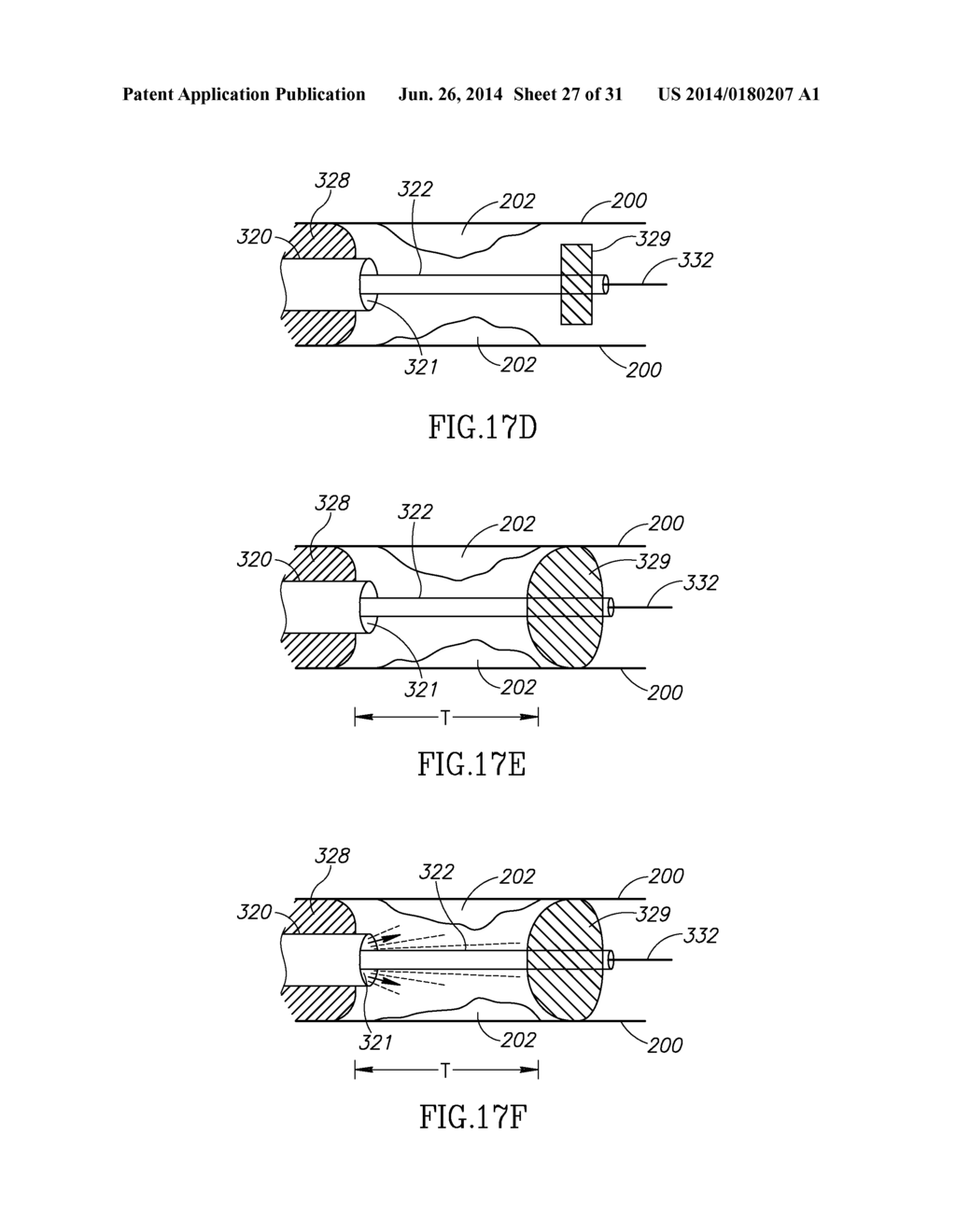 VARIABLE LENGTH CATHETER FOR DRUG DELIVERY - diagram, schematic, and image 28