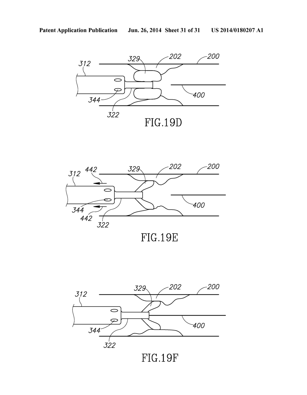 VARIABLE LENGTH CATHETER FOR DRUG DELIVERY - diagram, schematic, and image 32