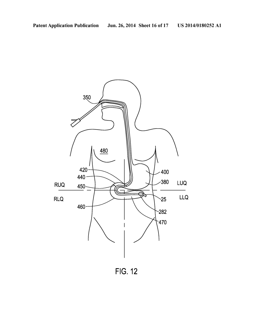 Feeding Tube with Inflatable Balloon Component - diagram, schematic, and image 17