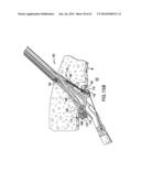 ARTICULATING SUTURING DEVICE AND METHOD diagram and image