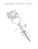 ARTICULATING SUTURING DEVICE AND METHOD diagram and image