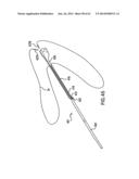 ARTICULATING SUTURING DEVICE AND METHOD diagram and image