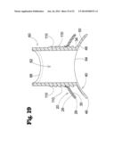 VASCULAR ANASTOMOSIS DEVICE AND METHOD diagram and image