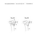 METHODS AND SYSTEMS FOR PLANNING AND PERFORMING AN OSTEOTOMY diagram and image