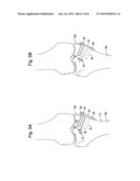 METHODS AND SYSTEMS FOR PLANNING AND PERFORMING AN OSTEOTOMY diagram and image