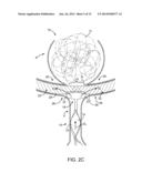 ANEURYSM OCCLUSION SYSTEM AND METHOD diagram and image