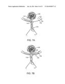 ANEURYSM OCCLUSION SYSTEM AND METHOD diagram and image