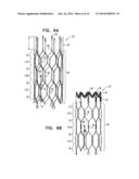 WIRELESS ENDOVASCULAR STENT-BASED ELECTRODES diagram and image