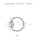 ACCOMMODATING INTRAOCULAR LENS diagram and image