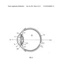 ACCOMMODATING INTRAOCULAR LENS diagram and image