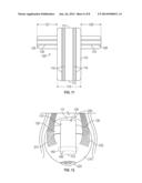 RETINAL REPAIR DEVICE AND METHOD diagram and image