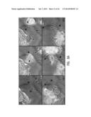 Use of Stem Cells to Prevent Neuronal Dieback diagram and image