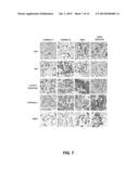 DIAGNOSING SUBSETS OF TRIPLE-NEGATIVE BREAST CANCER diagram and image