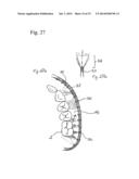 IMPRESSION TRAY, AND METHOD FOR CAPTURING STRUCTURES, ARRANGEMENTS OR     SHAPES, IN PARTICULAR IN THE MOUTH OR HUMAN BODY diagram and image