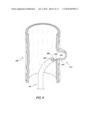 DEVICE AND METHOD FOR TREATING DIVERTICULAR DISEASE diagram and image