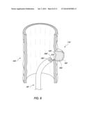 DEVICE AND METHOD FOR TREATING DIVERTICULAR DISEASE diagram and image