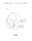 ENERGY-BASED TISSUE TIGHTENING SYSTEM diagram and image