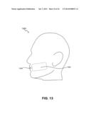 ENERGY-BASED TISSUE TIGHTENING SYSTEM diagram and image