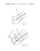 SYSTEMS AND METHOD FOR BYPASSING AN ANASTOMOSIS SITE diagram and image