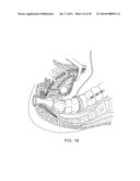 SYSTEMS AND METHOD FOR BYPASSING AN ANASTOMOSIS SITE diagram and image