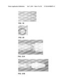 SYSTEMS AND METHOD FOR BYPASSING AN ANASTOMOSIS SITE diagram and image