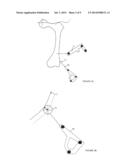 SYSTEM FOR DETERMINING THE POSITION OF A KNEE PROSTHESIS diagram and image