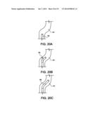 APPARATUS AND METHOD FOR ENDOSCOPIC COLECTOMY diagram and image