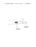 PERCUTANEOUS FLARING HAMMERTOE FIXATION IMPLANT AND INSTRUMENT diagram and image