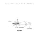 PERCUTANEOUS FLARING HAMMERTOE FIXATION IMPLANT AND INSTRUMENT diagram and image