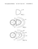 METHOD AND APPARATUS FOR CATHETER-BASED ANNULOPLASTY USING LOCAL     PLICATIONS diagram and image