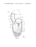 METHOD AND APPARATUS FOR CATHETER-BASED ANNULOPLASTY USING LOCAL     PLICATIONS diagram and image