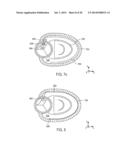 METHOD AND APPARATUS FOR CATHETER-BASED ANNULOPLASTY USING LOCAL     PLICATIONS diagram and image