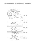 METHOD AND APPARATUS FOR CATHETER-BASED ANNULOPLASTY USING LOCAL     PLICATIONS diagram and image