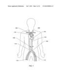 EXPANDABLE ILIAC SHEATH AND METHOD OF USE diagram and image