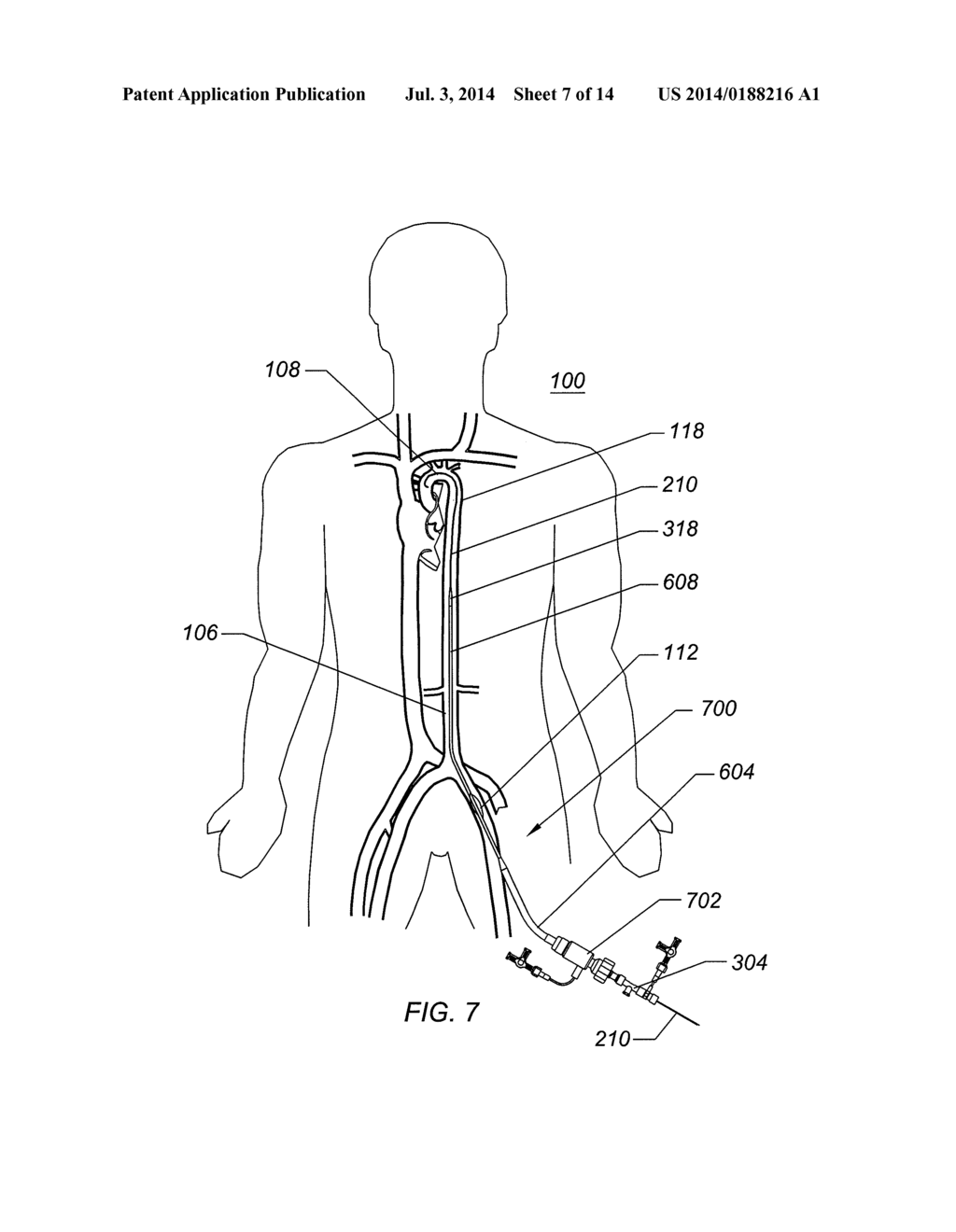 EXPANDABLE ILIAC SHEATH AND METHOD OF USE - diagram, schematic, and image 08