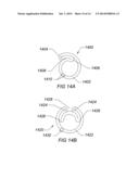 EXPANDABLE ILIAC SHEATH AND METHOD OF USE diagram and image