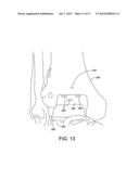 ANKLE REPLACEMENT SYSTEM AND METHOD diagram and image