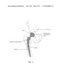 COMPUTER-GUIDED SYSTEM FOR ORIENTING THE ACETABULAR CUP IN THE PELVIS     DURING TOTAL HIP REPLACEMENT SURGERY diagram and image