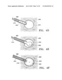 SUBCUTANEOUS CAVITY MARKING DEVICE AND METHOD diagram and image