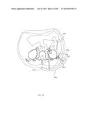 METHODS AND DEVICES FOR THERMALLY INDUCED HEPATIC NEUROMODULATION diagram and image