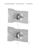 DEPLOYABLE JOINT INFECTION TREATMENT SYSTEM diagram and image