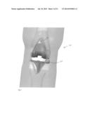 DEPLOYABLE JOINT INFECTION TREATMENT SYSTEM diagram and image