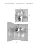 DEPLOYABLE JOINT INFECTION TREATMENT SYSTEM diagram and image