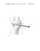 DEPLOYABLE JOINT INFECTION TREATMENT SYSTEM diagram and image