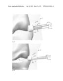 DEPLOYABLE JOINT INFECTION TREATMENT SYSTEM diagram and image