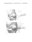 DEPLOYABLE JOINT INFECTION TREATMENT SYSTEM diagram and image