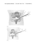 DEPLOYABLE JOINT INFECTION TREATMENT SYSTEM diagram and image