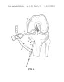 SYSTEM FOR ACL RECONSTRUCTION USING RETROGRADE CUTTER diagram and image